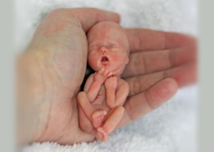 RIGHT TO LIFE - fetus in hand (from Prevent Disease Website)